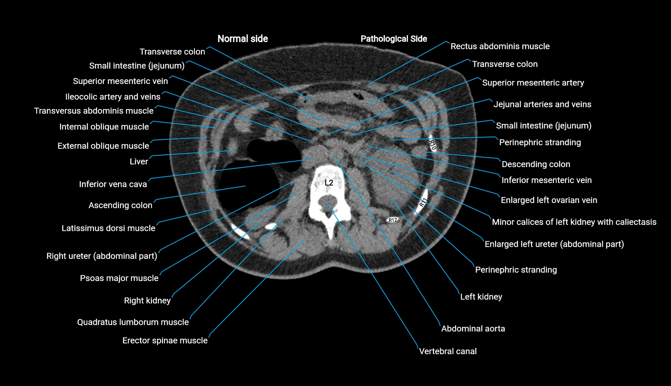 CT KUB axial cross sectional anatomy  radiology image -img-00201-00055.webp